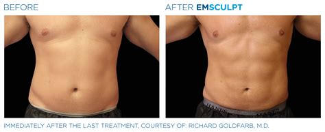 emsculpt sydney|Iconic Medispa .